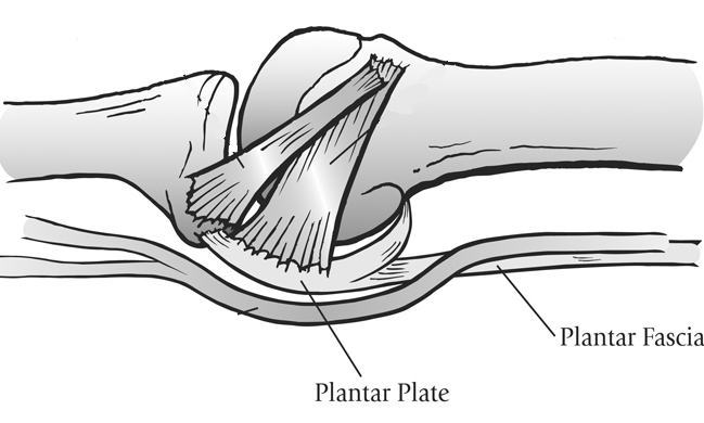 plantar plate surgical repair