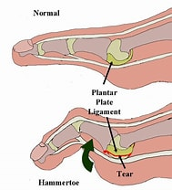 plantar plate ligament tear