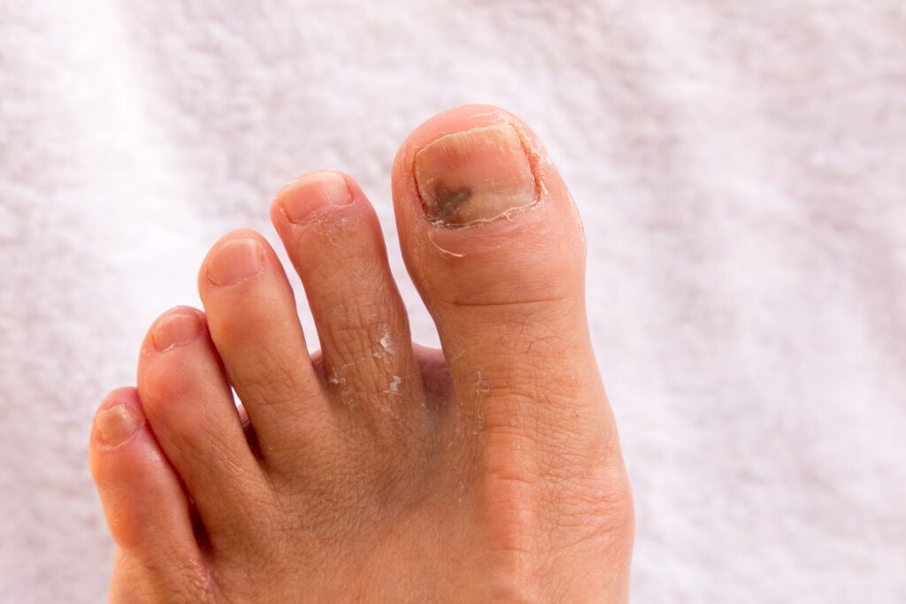 toenail fungus, fungal nail infection, onychomycosis, toenail fungus treatment, podiatry advice, onychomycosis cure, podiatrist recommended, toenail fungus experts, effective treatments, hydrogen peroxide myth, topical prescription therapies, oral medications, laser therapies, WeTreatFeet Podiatry, toenail fungus specialists, expert foot care