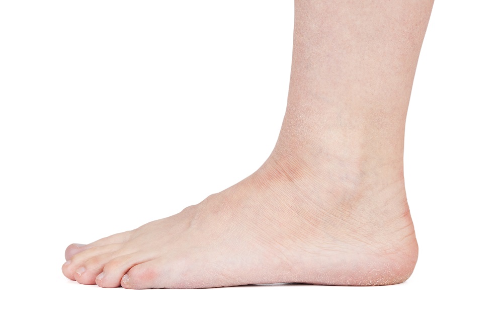 charcot foot treatment