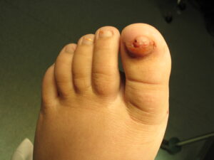 Ingrown toenail in children, Toenails Turn Yellow