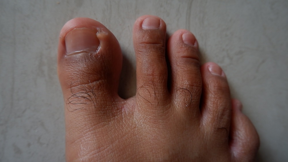 eradicate toenail fungus