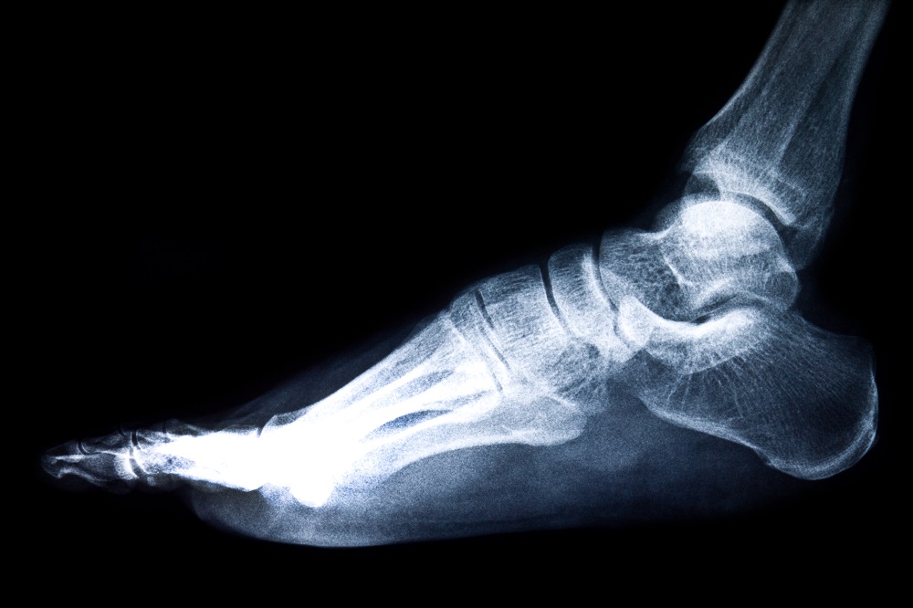 charcot foot diabetic complication