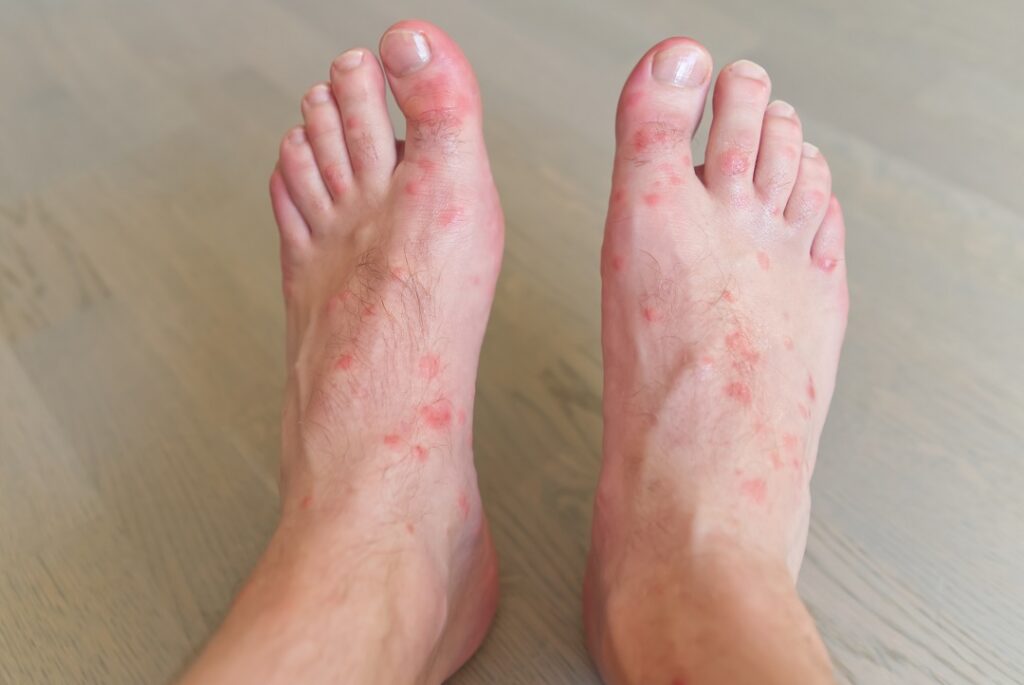 diabetic foot ulcers treatment