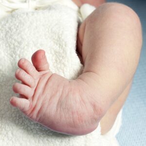 clubfoot correction at we treat feet podiatry