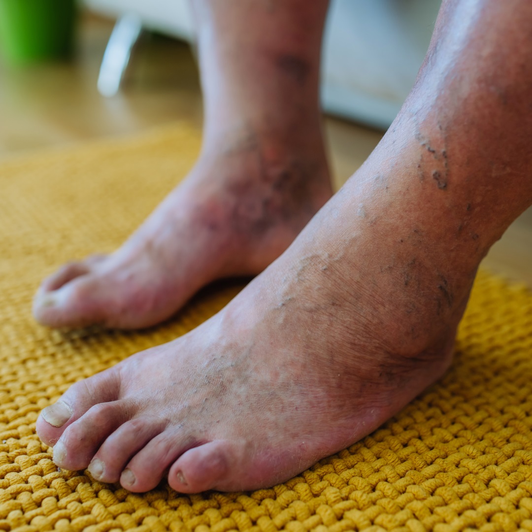 common foot infection treatment