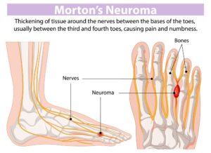 Morton's neuroma treatment