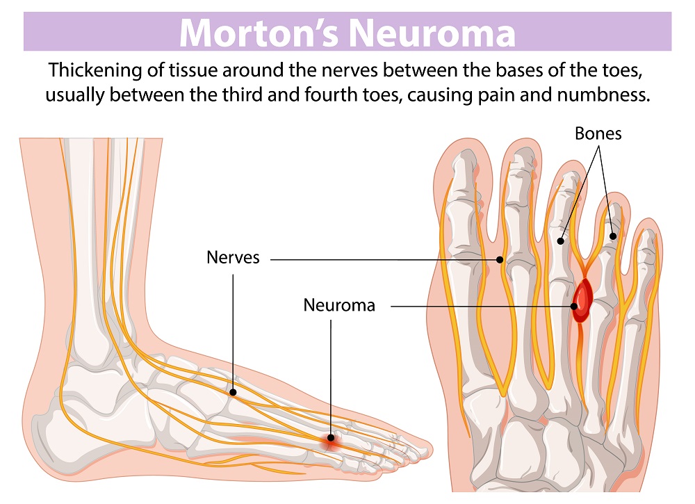 Morton's neuroma treatment